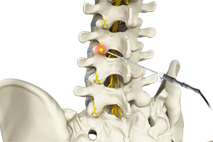 Radiofrequency Ablation Treatment - Harley Street Orthopedic Clinic Abu ...